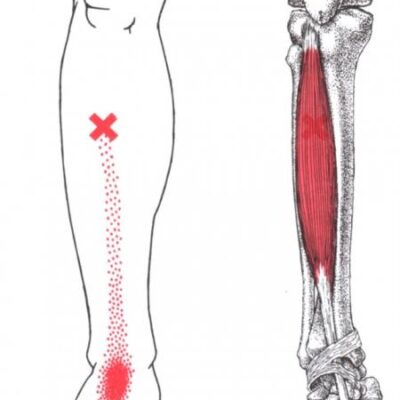 Tibialis Ant TrP - Geelong Myotherapy & Wellness Centre